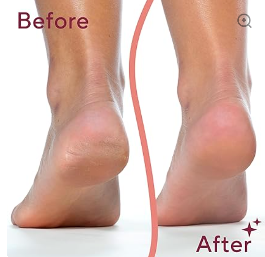 Electric Feet Callus Removers - tools to remove foot calluses,أجهزة إزالة مسامير القدم الكهربائية - أدوات لإزالة مسامير القدم