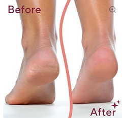 Electric Feet Callus Removers - tools to remove foot calluses,أجهزة إزالة مسامير القدم الكهربائية - أدوات لإزالة مسامير القدم